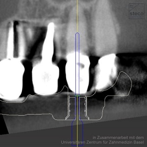 Detalle de la planificación de una endodoncia guiada con casquillos de Titanio de Steco