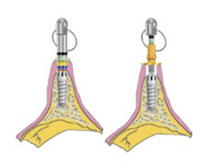 MEDIDOR GINGIVAL