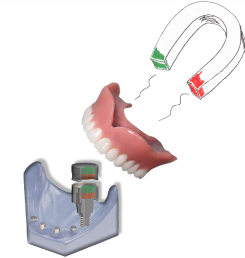 ALTERNATIVA LOCATOR® ATACHES TITANMAGNETICS CON IMANES PARA SOBREDENTADURAS SOBRE IMPLANTES