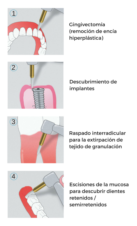 SOFT TISSUE TRIMMER