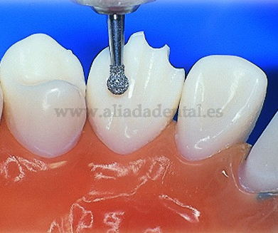 EDENTA FRESA DIAMANTE TURBINA 802 BOLA CON EXTENSION GRANO MEDIO DIAMETRO  08