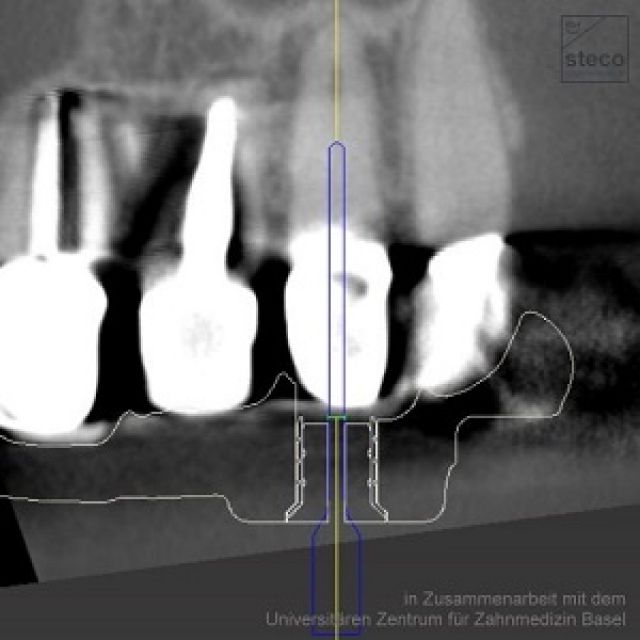 CASQUILLOS STECO DE TITANIO PARA ENDODONCIA GUIADA