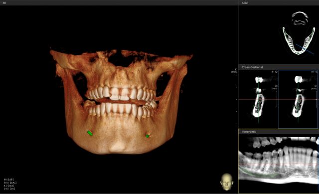 TAC 3D CBCT, Panorámico y Cefalometría - Genoray Papaya 3D Plus