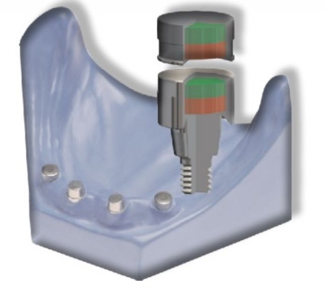 ALTERNATIVA LOCATOR® ATACHES TITANMAGNETICS CON IMANES PARA SOBREDENTADURAS SOBRE IMPLANTES