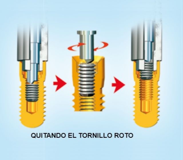 KIT DE EXTRACCION TORNILLOS ROTOS IMPLANTES DENTALES