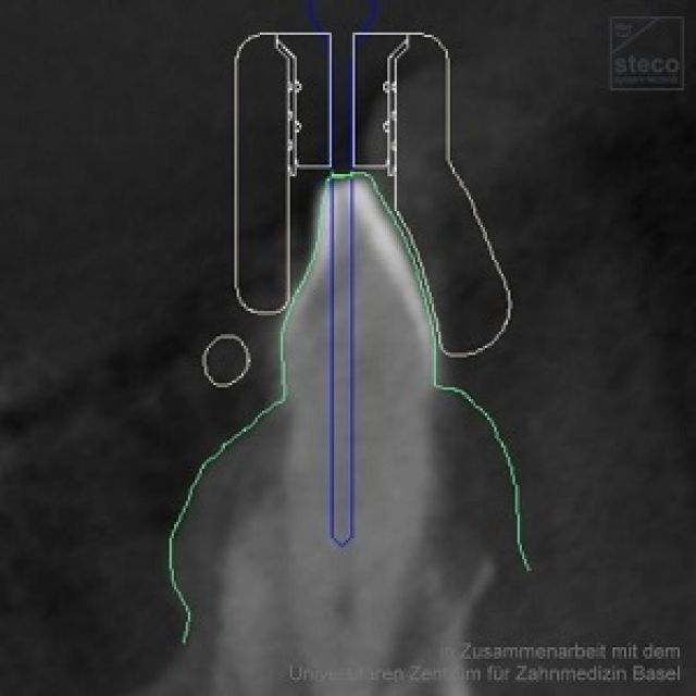 CASQUILLOS STECO DE TITANIO PARA ENDODONCIA GUIADA